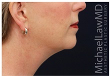 Facelift After Photo by Michael Law, MD; Raleigh, NC - Case 35676
