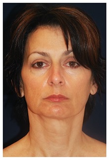 Facelift Before Photo by Michael Law, MD; Raleigh, NC - Case 35677
