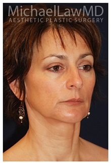 Facelift After Photo by Michael Law, MD; Raleigh, NC - Case 35677