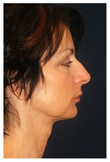 Facelift Before Photo by Michael Law, MD; Raleigh, NC - Case 35677