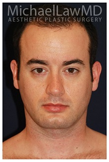 Facelift After Photo by Michael Law, MD; Raleigh, NC - Case 35686