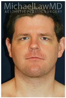 Facelift After Photo by Michael Law, MD; Raleigh, NC - Case 35687