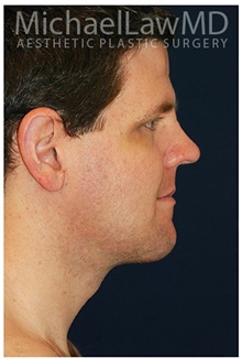 Facelift After Photo by Michael Law, MD; Raleigh, NC - Case 35687