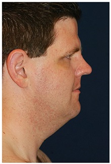 Facelift Before Photo by Michael Law, MD; Raleigh, NC - Case 35687