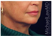 Facelift After Photo by Michael Law, MD; Raleigh, NC - Case 35691