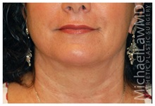 Facelift After Photo by Michael Law, MD; Raleigh, NC - Case 35692