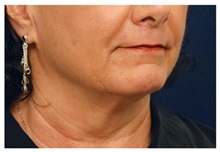 Facelift Before Photo by Michael Law, MD; Raleigh, NC - Case 35692