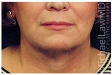 Facelift After Photo by Michael Law, MD; Raleigh, NC - Case 35693