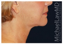 Facelift After Photo by Michael Law, MD; Raleigh, NC - Case 35699