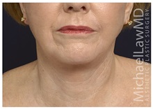 Facelift After Photo by Michael Law, MD; Raleigh, NC - Case 35709