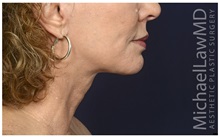 Facelift After Photo by Michael Law, MD; Raleigh, NC - Case 35710