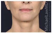 Facelift After Photo by Michael Law, MD; Raleigh, NC - Case 35712