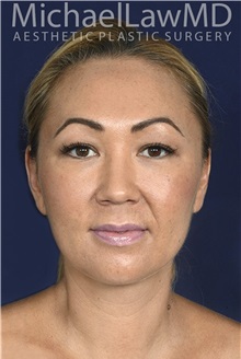 Facelift After Photo by Michael Law, MD; Raleigh, NC - Case 35713