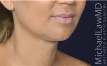 Facelift After Photo by Michael Law, MD; Raleigh, NC - Case 35714