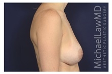 Breast Augmentation After Photo by Michael Law, MD; Raleigh, NC - Case 35715