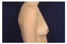 Breast Augmentation Before Photo by Michael Law, MD; Raleigh, NC - Case 35715