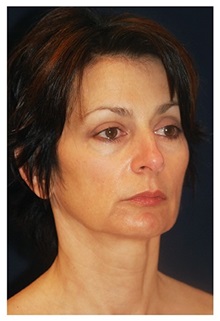 Chin Augmentation Before Photo by Michael Law, MD; Raleigh, NC - Case 35716