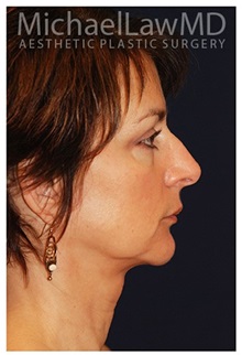 Chin Augmentation After Photo by Michael Law, MD; Raleigh, NC - Case 35716