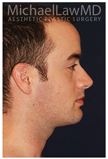Chin Augmentation After Photo by Michael Law, MD; Raleigh, NC - Case 35717