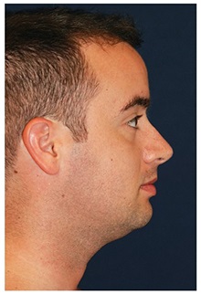 Chin Augmentation Before Photo by Michael Law, MD; Raleigh, NC - Case 35717