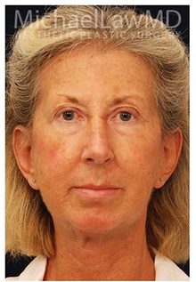 Chin Augmentation After Photo by Michael Law, MD; Raleigh, NC - Case 35718