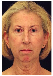 Chin Augmentation Before Photo by Michael Law, MD; Raleigh, NC - Case 35718