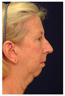 Chin Augmentation Before Photo by Michael Law, MD; Raleigh, NC - Case 35718