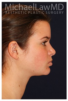Chin Augmentation After Photo by Michael Law, MD; Raleigh, NC - Case 35719