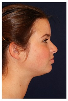 Chin Augmentation Before Photo by Michael Law, MD; Raleigh, NC - Case 35719