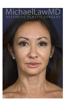 Dermal Fillers After Photo by Michael Law, MD; Raleigh, NC - Case 35723