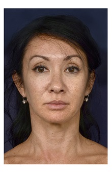 Dermal Fillers Before Photo by Michael Law, MD; Raleigh, NC - Case 35723
