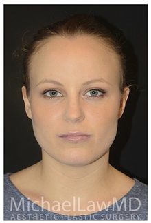 Dermal Fillers After Photo by Michael Law, MD; Raleigh, NC - Case 35724