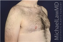 Male Breast Reduction After Photo by Michael Law, MD; Raleigh, NC - Case 35726