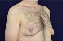 Male Breast Reduction Before Photo by Michael Law, MD; Raleigh, NC - Case 35726