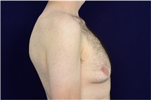 Male Breast Reduction Before Photo by Michael Law, MD; Raleigh, NC - Case 35726