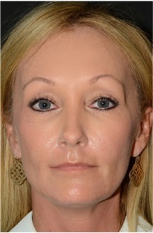 Dermal Fillers Before Photo by Michael Law, MD; Raleigh, NC - Case 35735