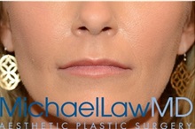 Dermal Fillers After Photo by Michael Law, MD; Raleigh, NC - Case 35735