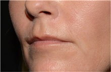 Dermal Fillers Before Photo by Michael Law, MD; Raleigh, NC - Case 35735