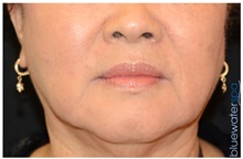 Dermal Fillers After Photo by Michael Law, MD; Raleigh, NC - Case 35746