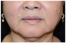 Dermal Fillers Before Photo by Michael Law, MD; Raleigh, NC - Case 35746
