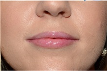 Dermal Fillers After Photo by Michael Law, MD; Raleigh, NC - Case 35752