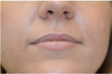 Dermal Fillers Before Photo by Michael Law, MD; Raleigh, NC - Case 35752