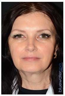 Dermal Fillers After Photo by Michael Law, MD; Raleigh, NC - Case 35753