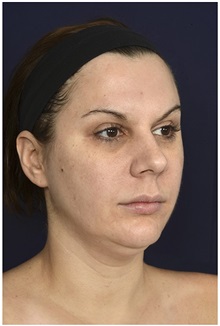 Facelift Before Photo by Michael Law, MD; Raleigh, NC - Case 35754