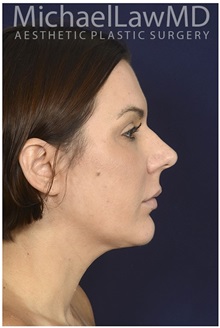 Facelift After Photo by Michael Law, MD; Raleigh, NC - Case 35754