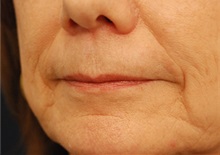 Dermal Fillers Before Photo by Michael Law, MD; Raleigh, NC - Case 35755