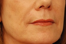 Dermal Fillers After Photo by Michael Law, MD; Raleigh, NC - Case 35755