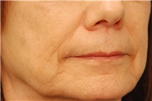 Dermal Fillers Before Photo by Michael Law, MD; Raleigh, NC - Case 35755