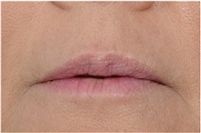 Dermal Fillers After Photo by Michael Law, MD; Raleigh, NC - Case 35757