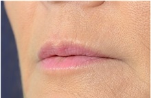 Dermal Fillers After Photo by Michael Law, MD; Raleigh, NC - Case 35757